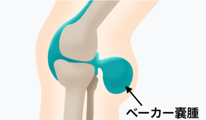 膝の裏が膨れてたら、ベーカー嚢腫かも