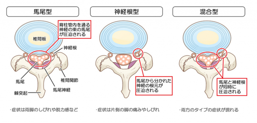 腰部脊柱管狭窄症とは?