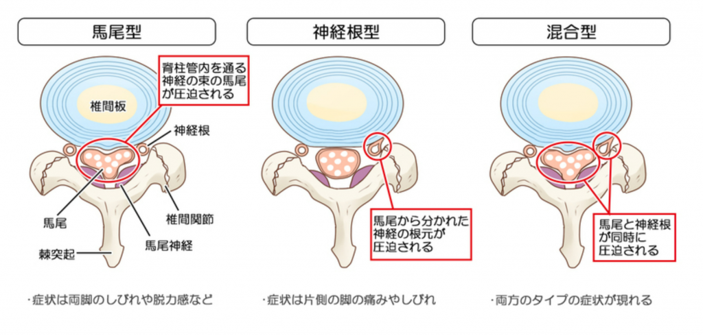  腰部脊柱管狭窄症とは？ 