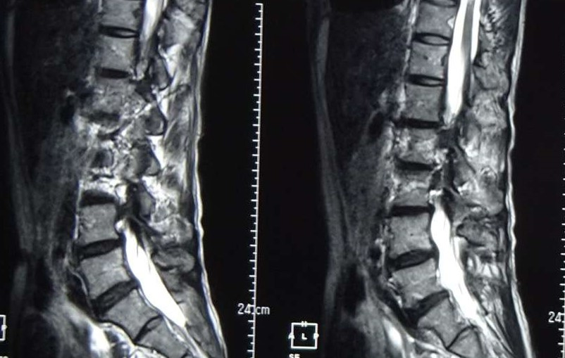 こんな症状があったら腰部脊柱管狭窄症かも