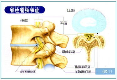 腰部脊柱管狭窄症1