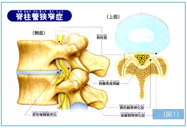 腰部脊柱管狭窄症１　