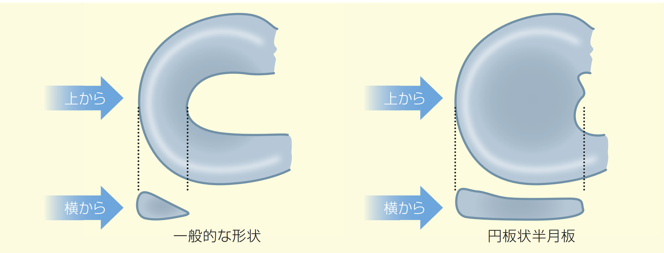 運動している子供が膝が痛いと言ったら、円板状半月板かも！