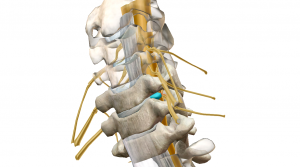頚椎椎間板ヘルニアの治療