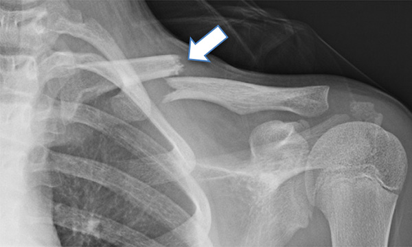 鎖骨骨折１(引用元：一般社団法人　日本骨折治療学会)