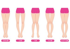 O脚X脚の矯正治療